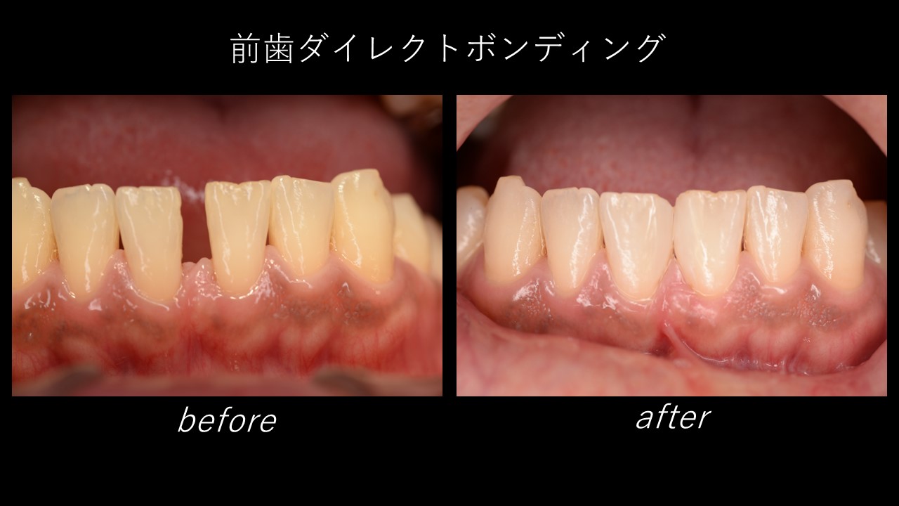 オーラルケア　麻布十番　麻布　三田　歯科　港区　虫歯　むし歯　カリエス　治療　歯　ダイレクトボンディング　白い詰め物　詰め物