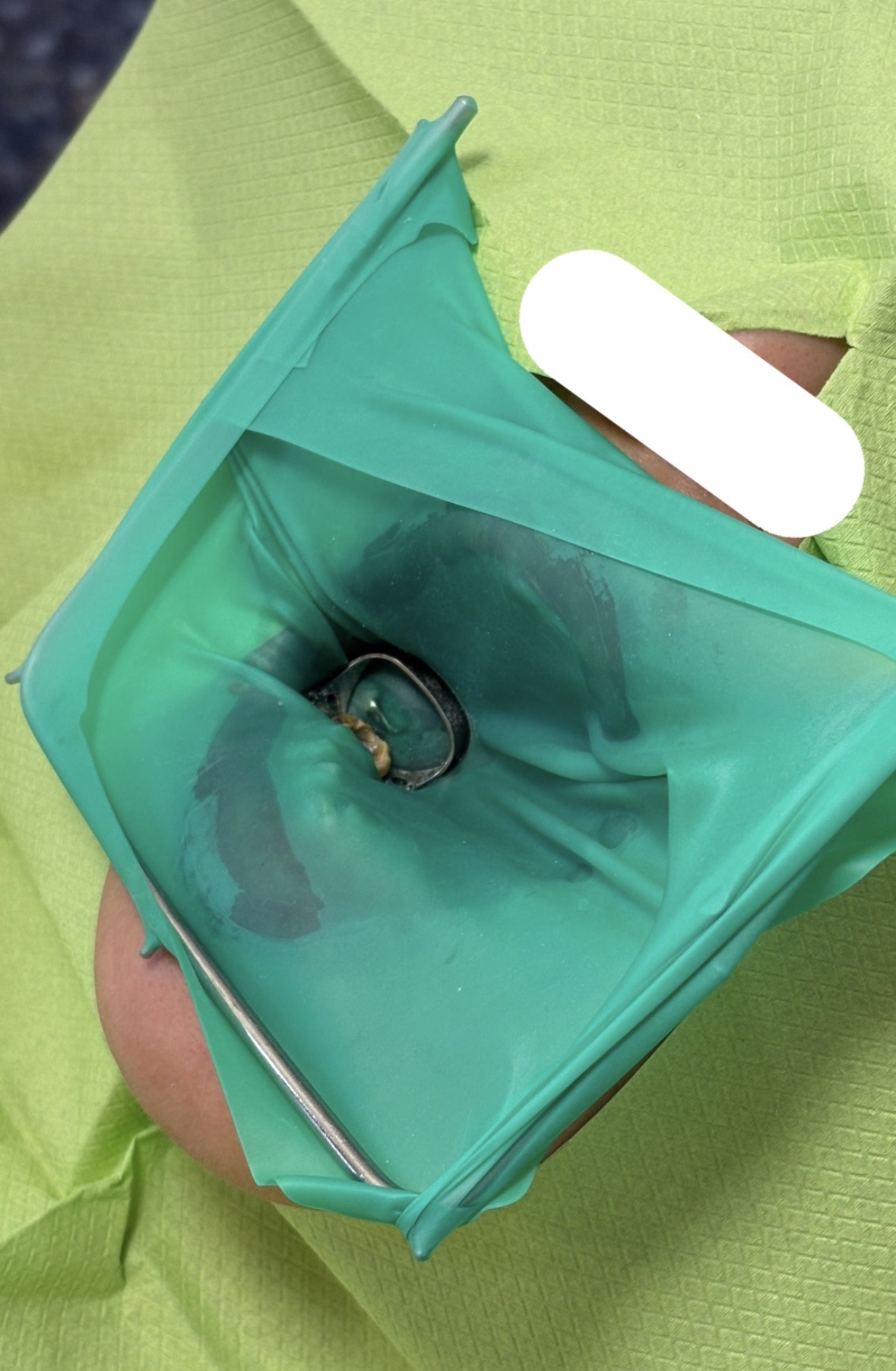 ラバーダム防湿を行い、治療する歯だけをゴムシートから露出させた口腔内の様子