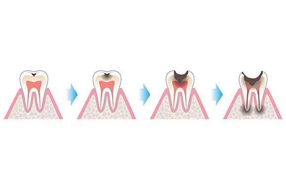 虫歯の治療内容は、進行度によって変わる
