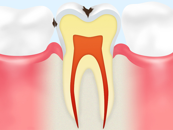 C1（エナメル質の虫歯）