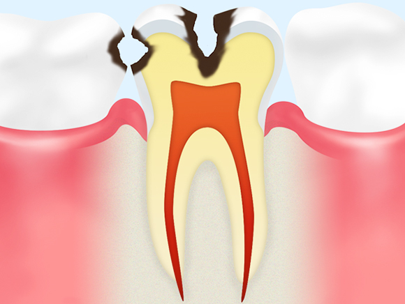 C2（象牙質に達した虫歯）