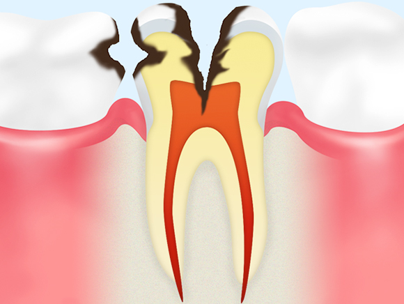 C3（神経に達した虫歯）