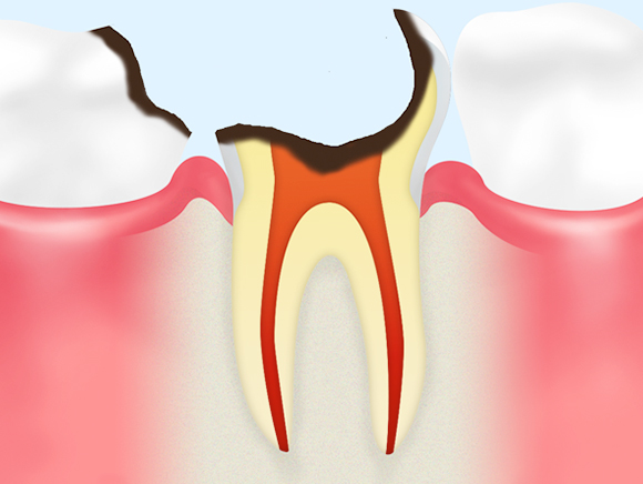 C4（歯根に達した虫歯）