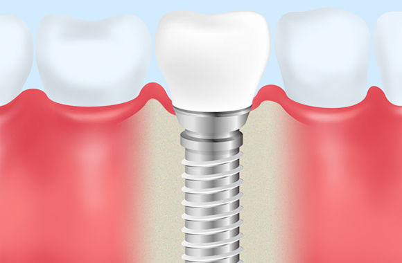 インプラント
