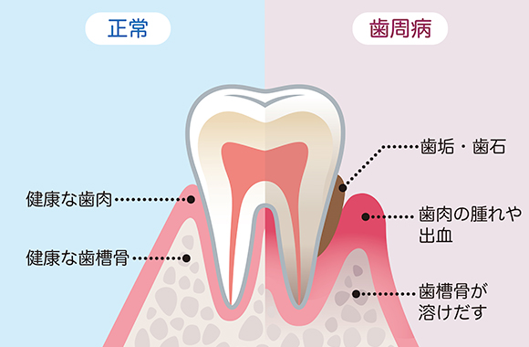 はじめは痛みのない『歯周病』ほうっておくとどうなる？